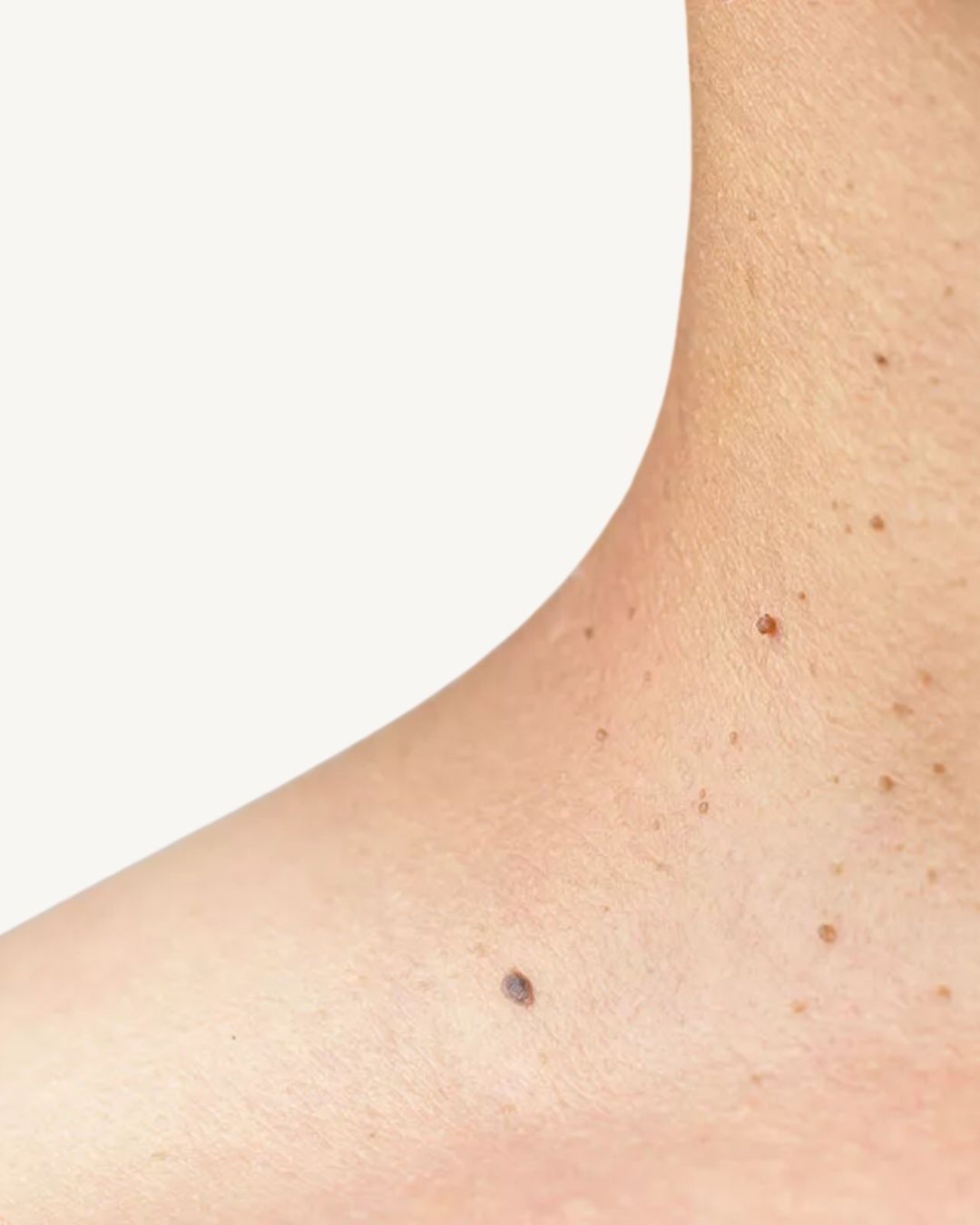 Skin Tags