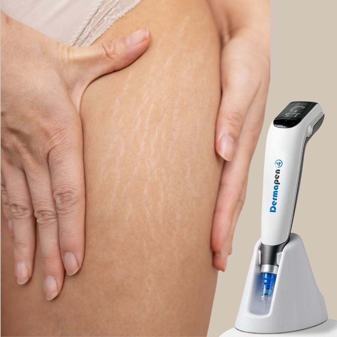 Behandling av strekkmerker