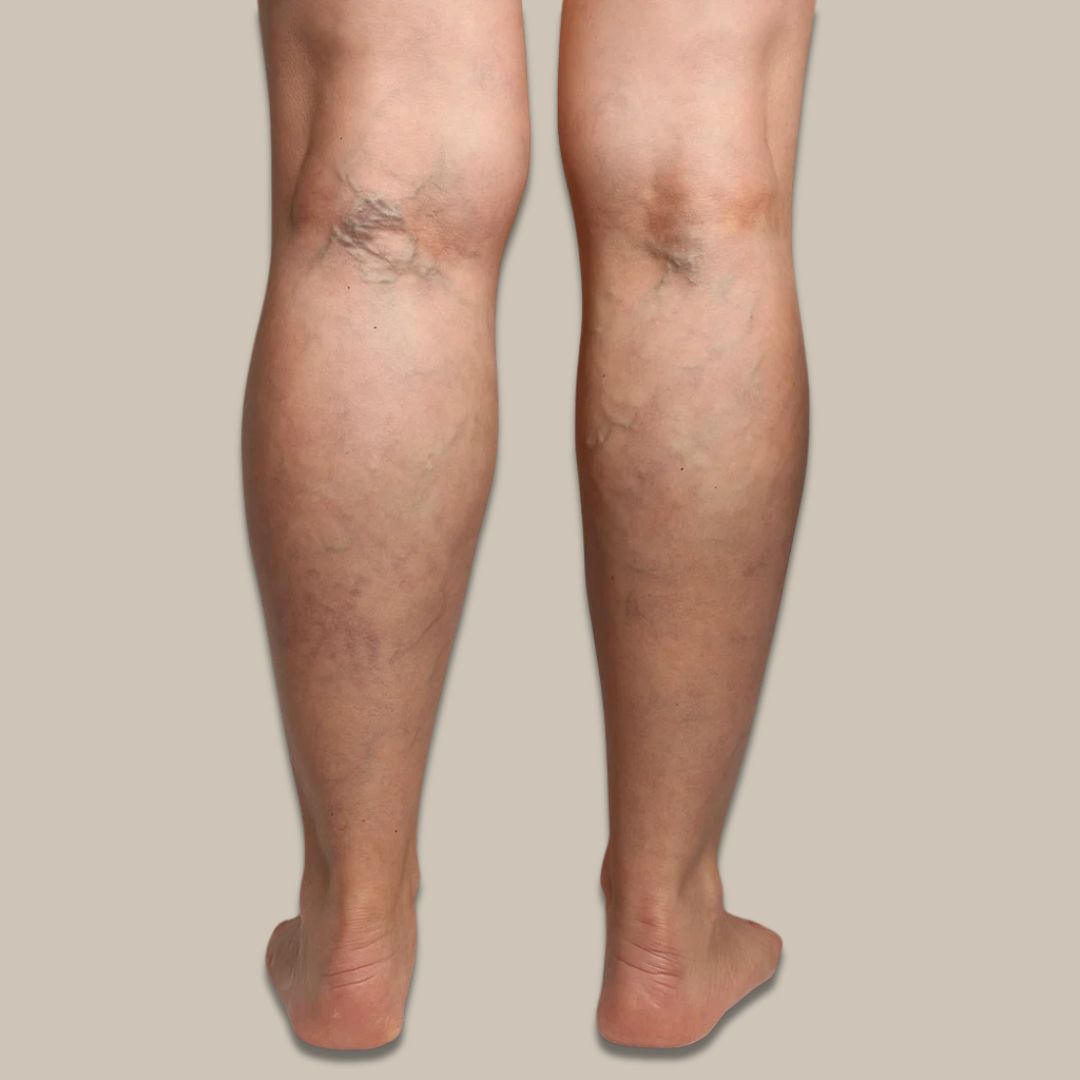 Åreknuter | Aerolase® Laser