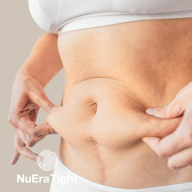 Cellulitter mage Oslo | Uten kirurgi med NuEra® Tight | CLINICA – Dr ...